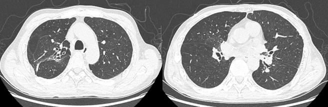 🌟抗肺最新进展与消息🌟