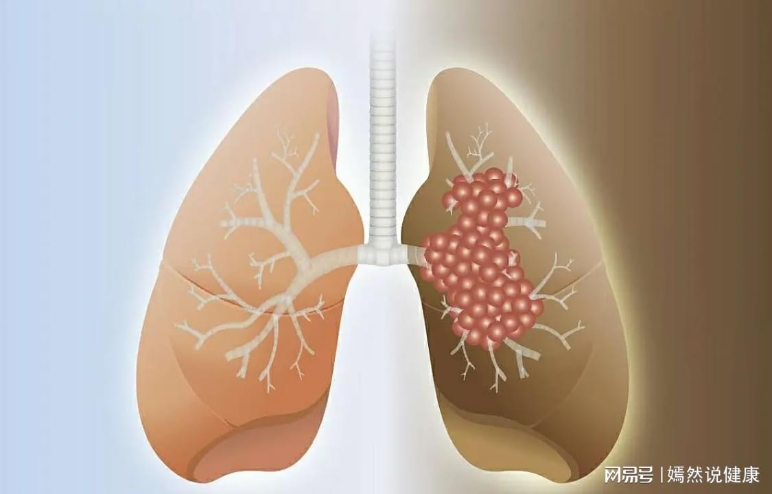 晚期肺癌最新治疗方法详解，步骤指南与策略探讨