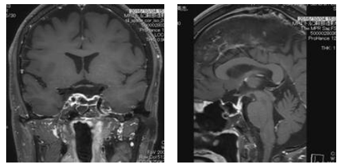 脂囊瘤最新治疗方法详解，观点论述与治疗方案更新