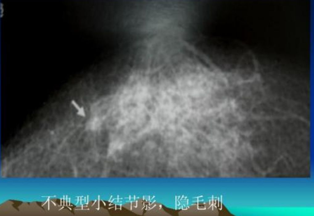 鼻咽癌最新分期解读与小巷特色小店探秘