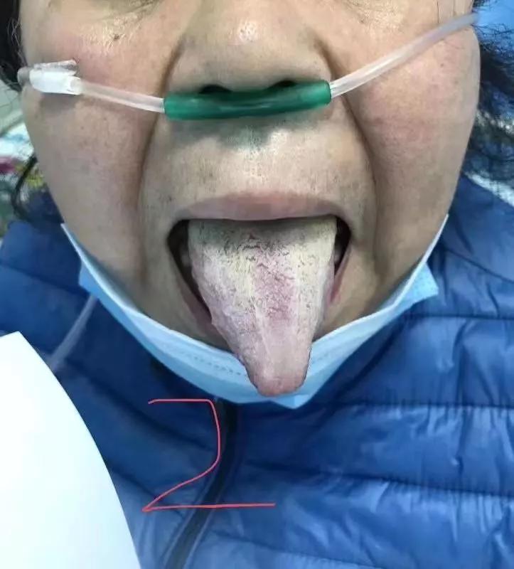 新冠肺炎最新治疗方案发布