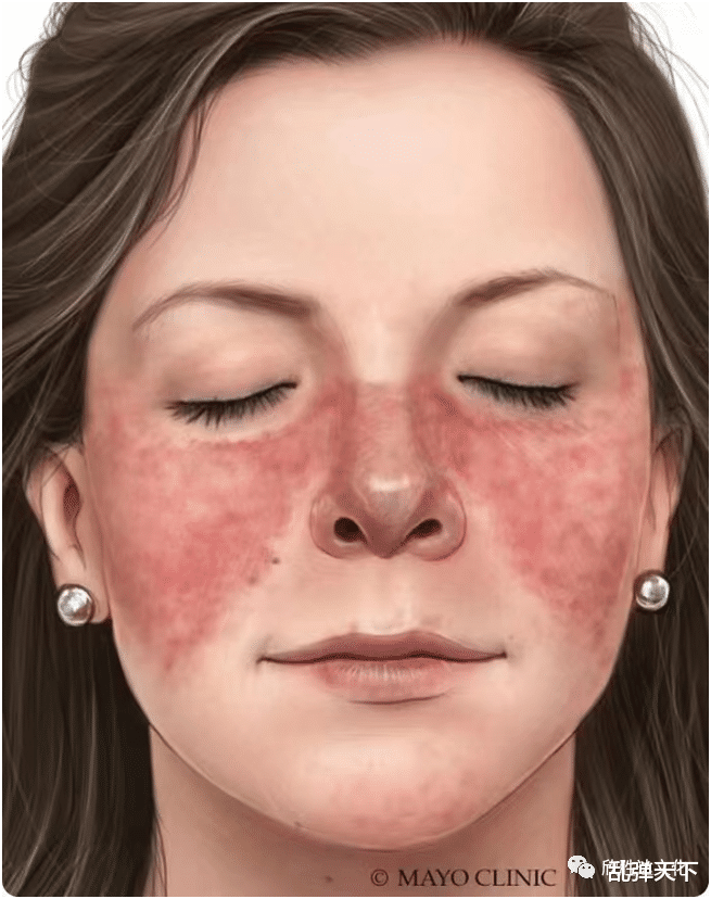 红斑狼疮最新动态,观点论述与解析揭秘