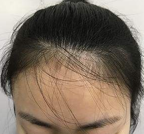 脱发最新突破揭秘,巷弄深处的秘密宝藏助力解决脱发问题