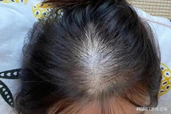 脱发最新突破揭秘,巷弄深处的秘密宝藏助力解决脱发问题