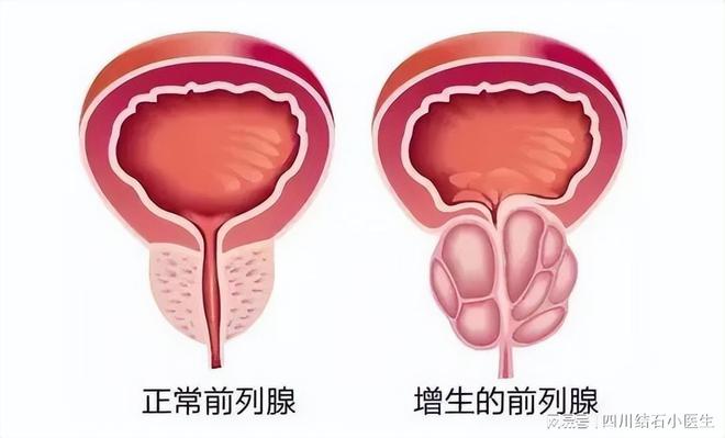 前列腺最新治疗技术揭秘,创新疗法助力患者康复
