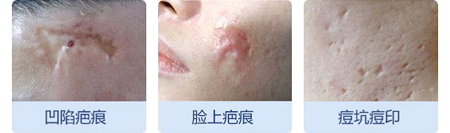 最新疤痕修复技术,从伤痕到自信的转变之路