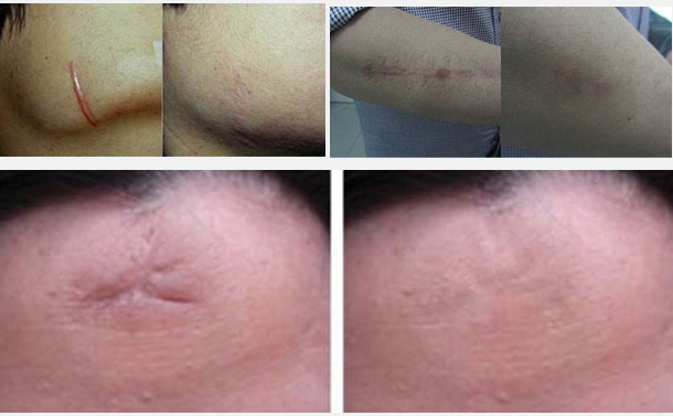 最新疤痕修复技术,从伤痕到自信的转变之路