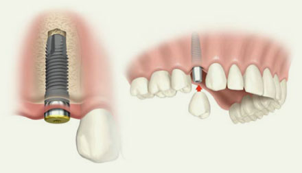 种植牙最新动态,奇妙旅程中的牙齿故事与友情力量探索