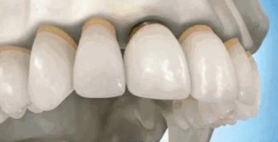 种植牙最新动态与相关论述概述